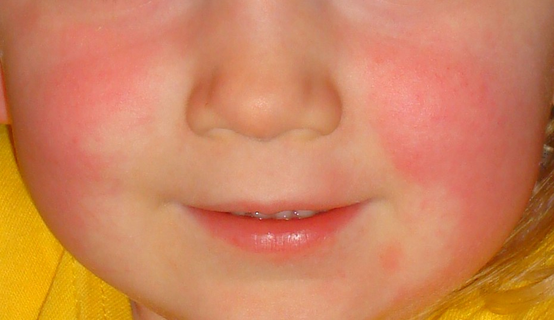 Illustration for article titled A new case of Scarlet Fever
